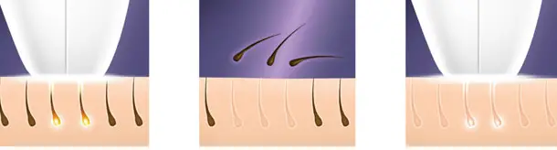 Epilacija IPL metodom ili fotoepilacija je najsavremenija metoda uklanjanja dlačica