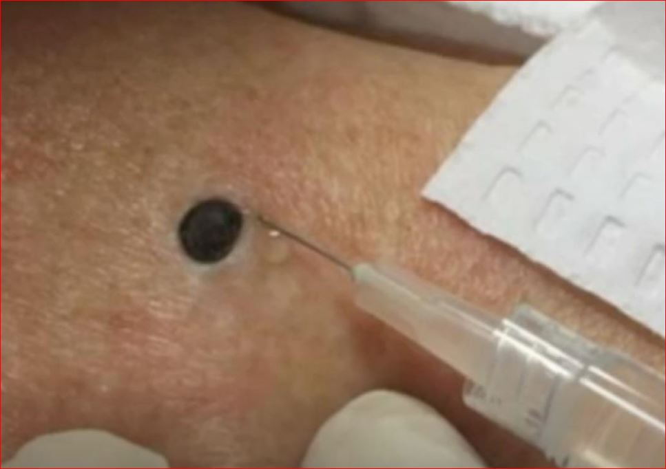 ŽENA JE GAJILA OVO NA LEĐIMA: Kada je doktorka uzela špric i bocnula, shvatit ćete zašto je SNIMAK pregledalo 33 miliona ljudi! - featured image