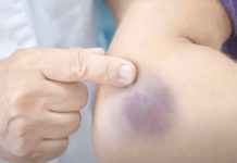 NIKAD NE BISTE POGODILI ZAŠTO SE MODRICE JAVLJAJU PO TIJELU: Nema veze sa POVREDAMA, PRAVI RAZLOGĆE VAS ŠOKIRATI NIKAD NE BISTE POGODILI ZAŠTO SE MODRICE JAVLJAJU PO TIJELU: Nema veze sa POVREDAMA, PRAVI RAZLOGĆE VAS ŠOKIRATI - featured image