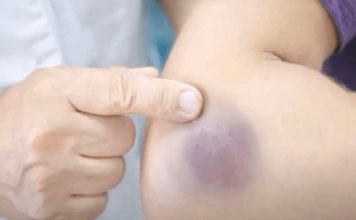 NIKAD NE BISTE POGODILI ZAŠTO SE MODRICE JAVLJAJU PO TIJELU: Nema veze sa POVREDAMA, PRAVI RAZLOGĆE VAS ŠOKIRATI NIKAD NE BISTE POGODILI ZAŠTO SE MODRICE JAVLJAJU PO TIJELU: Nema veze sa POVREDAMA, PRAVI RAZLOGĆE VAS ŠOKIRATI - featured image