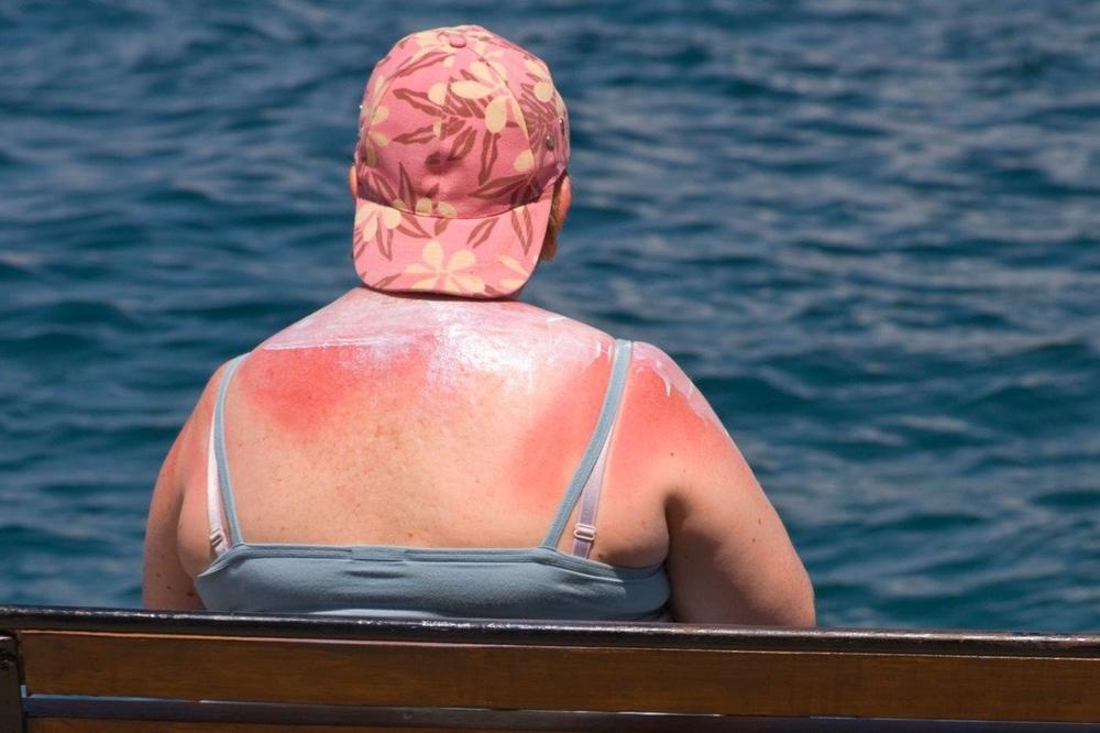 Ako izgorite na suncu, ne stavljajte jogurt ili kiselo mleko! To je najgora stvar, evo šta zaista pomaže - featured image Ako izgorite na suncu, ne stavljajte jogurt ili kiselo mleko! To je najgora stvar, evo šta zaista pomaže - featured image