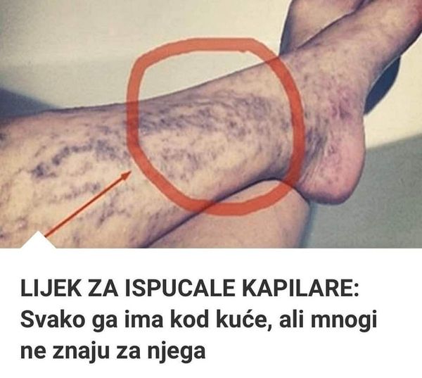 Svatko kod kuće ima lijek za popucale kapilare, ali mnogi ljudi to ne znaju! - featured image Svatko kod kuće ima lijek za popucale kapilare, ali mnogi ljudi to ne znaju! - featured image