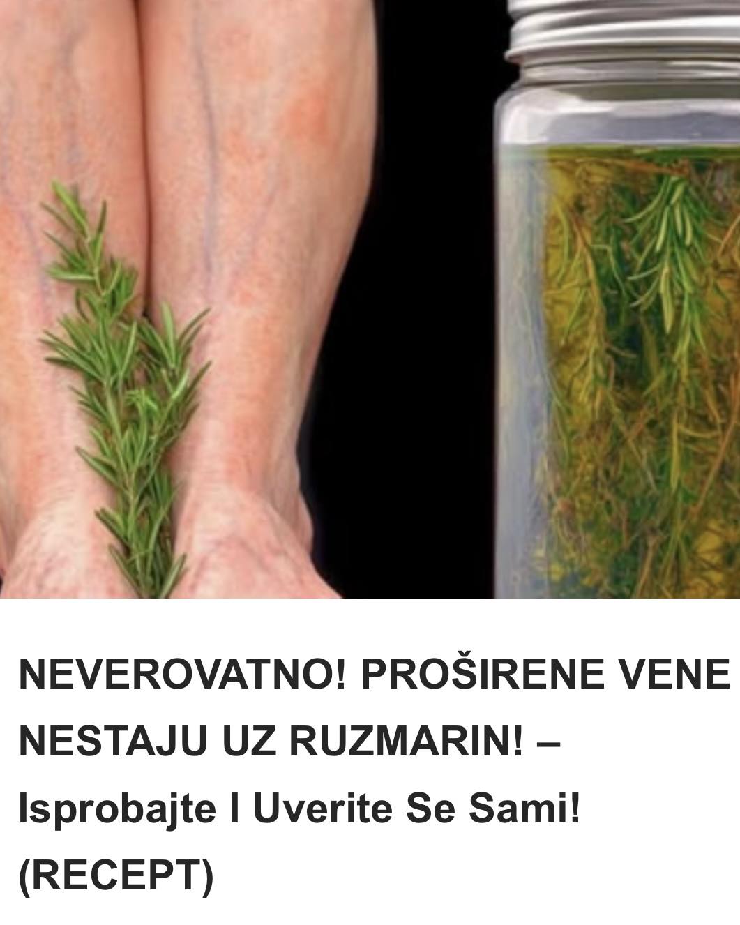 PROŠIRENE VENE NESTAJU UZ RUZMARIN! –Odmah isprobajte i uvjerite se sami! (RECEPT) - featured image PROŠIRENE VENE NESTAJU UZ RUZMARIN! –Odmah isprobajte i uvjerite se sami! (RECEPT) - featured image