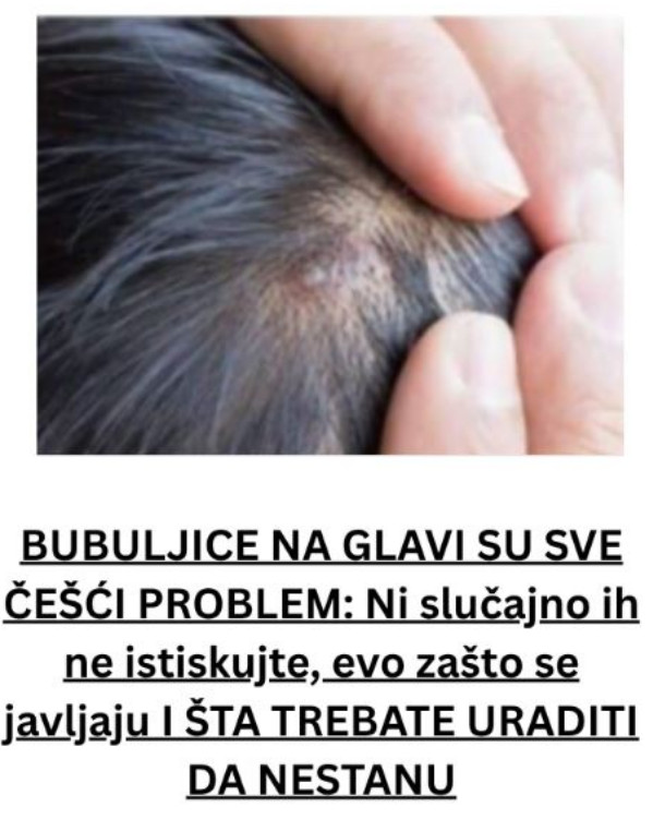 BUBULJICE NA GLAVI SU SVE ČEŠĆI PROBLEM: Ni slučajno ih ne istiskujte, evo zašto se javljaju I ŠTA TREBATE URADITI DA NESTANU - featured image BUBULJICE NA GLAVI SU SVE ČEŠĆI PROBLEM: Ni slučajno ih ne istiskujte, evo zašto se javljaju I ŠTA TREBATE URADITI DA NESTANU - featured image