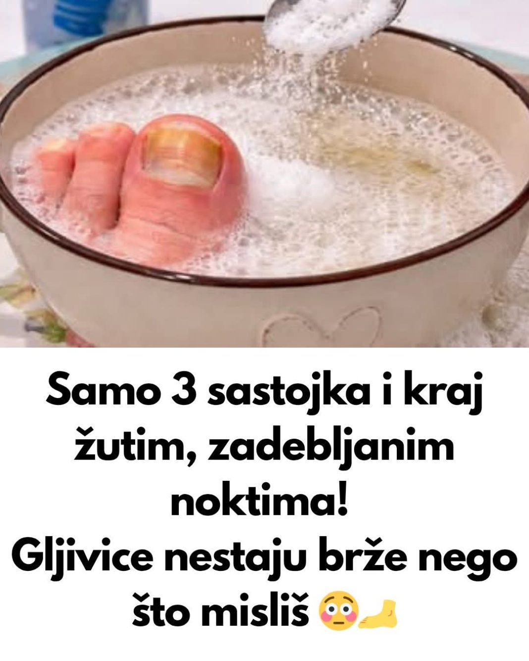 UZ P0MOĆ 3 sastojka riješite se žutih i zadebljalih noktiju! GLJIVICE NA N0KTIMA KA0 RUK0M 0DNESENE… - featured image
