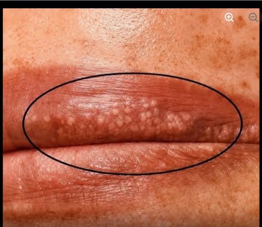 Bele fleke na usnama ili intimnom području? Ne ignorišite ove znake upozorenja! Bele fleke na usnama ili intimnom području? Ne ignorišite ove znake upozorenja! - featured image